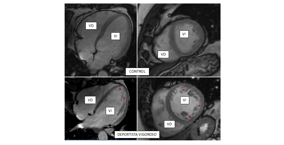 Ejercicio vigoroso, corazón esponjoso