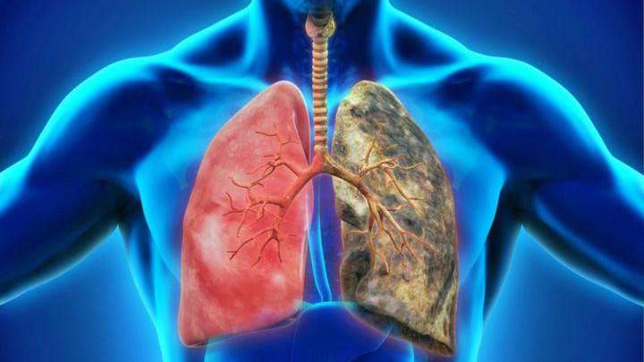 Nuevos avances en el papel del microambiente tumoral en el cáncer de pulmón en pacientes con EPOC