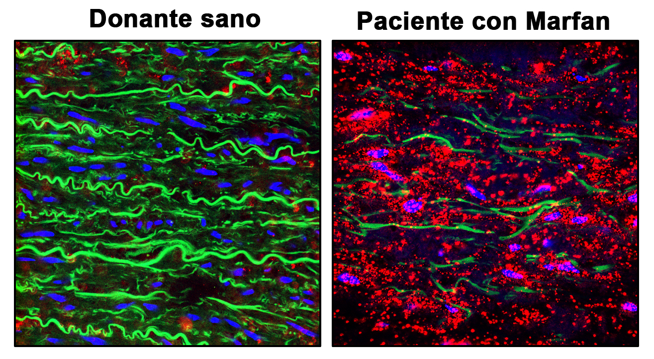 La inhibición de dos proteínas activadas por el óxido nítrico revierte los aneurismas de aorta del síndrome de Marfan