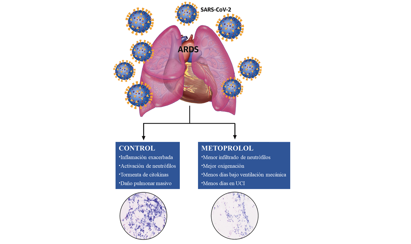 Un fármaco de menos de 2 euros demuestra ser útil en pacientes críticos con COVID-19