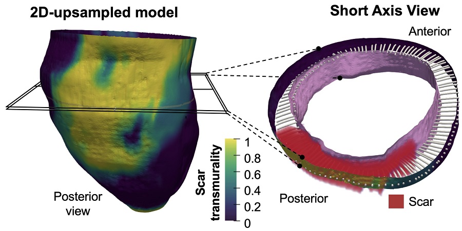 La evaluación 3D del daño cicatricial tras un infarto permite aumentar el valor pronóstico de la resonancia magnética cardíaca