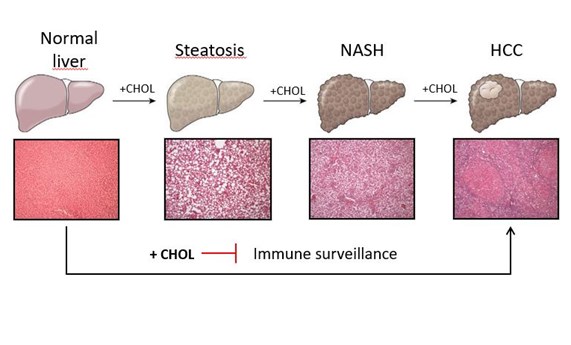 Revelan un papel clave del colesterol pero no de la esteatosis en el desarrollo del carcinoma hepatocelular