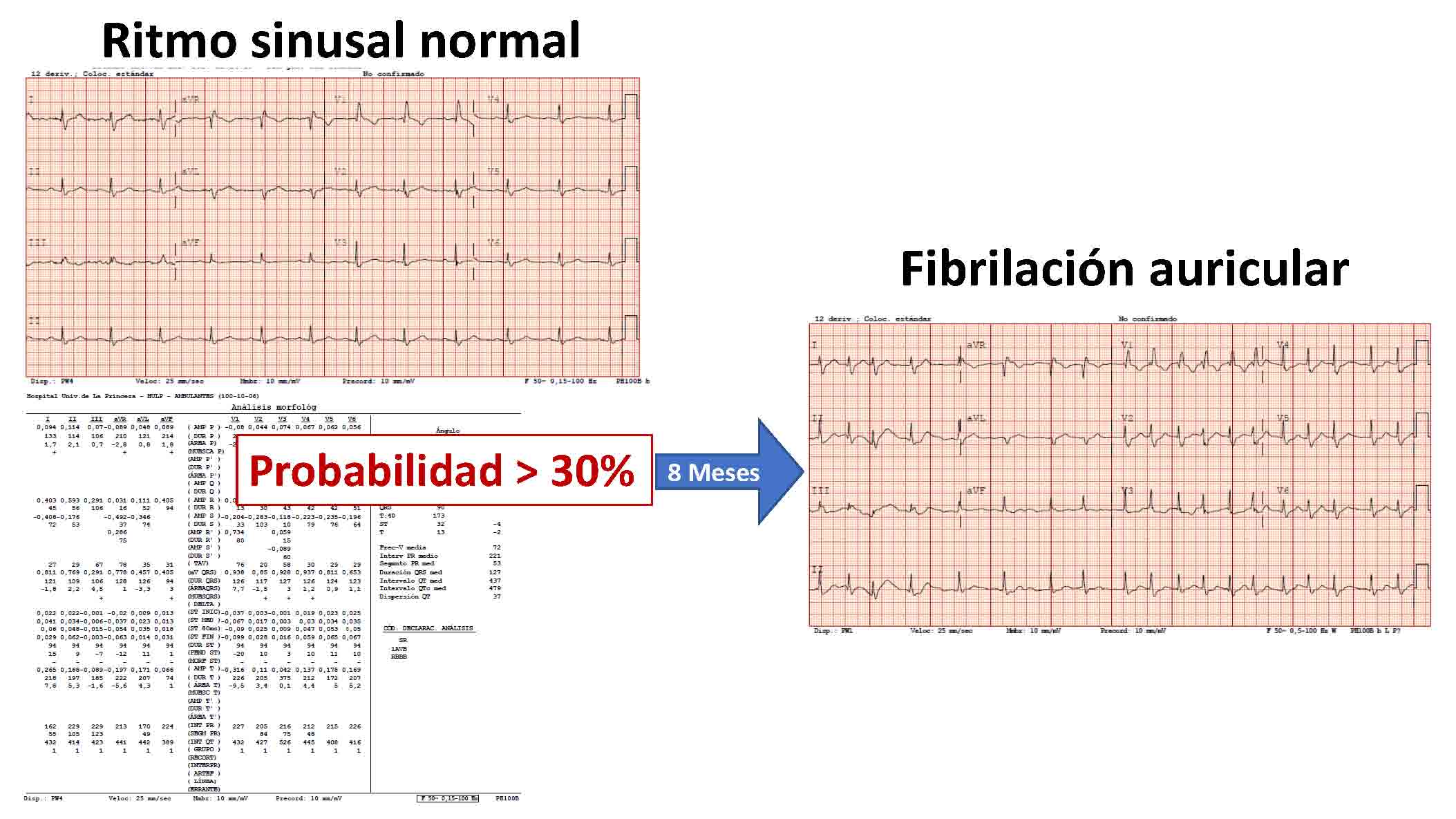Análisis de electrocardiogramas con big data para predecir el riesgo de fibrilación auricular
