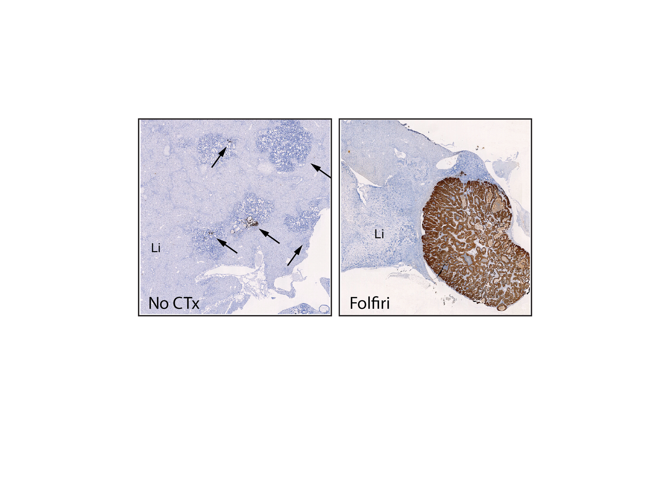 Científicos descubren la clave de la reaparición del cáncer  de colon después de la quimioterapia