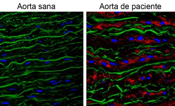 La acumulación de la proteína Versicano es responsable de los aneurismas de aorta del síndrome de Marfan La acumulación de la proteína Versicano es responsable de los aneurismas de aorta del síndrome de Marfan