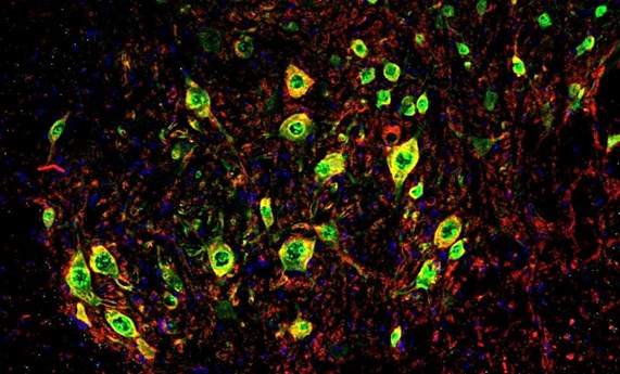 La FDA concede la designación de medicamento huérfano a una terapia génica para la ELA La FDA concede la designación de medicamento huérfano a una terapia génica para la ELA