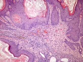 Demuestran el papel que ejerce la proteína IKKbeta en el cáncer de piel