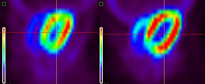 Relacionan el uso de nuevos fármacos contra el cáncer con problemas cardiovasculares
